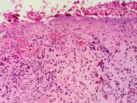 Histologie van orf (ecthyma contagiosum)