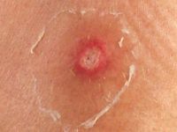 Ecthyma gangrenosum door Pseudomonas sepsis