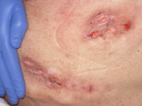 Ecthyma gangrenosum door Pseudomonas sepsis