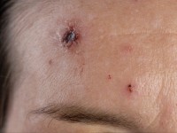 ecthyma (uitgeponst ulcus t.g.v. streptococcen)