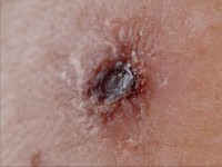 ecthyma (uitgeponst ulcus t.g.v. streptococcen)