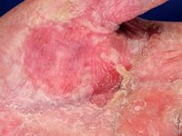 Ectodermale dysplasie