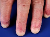 Ectodermale dysplasie