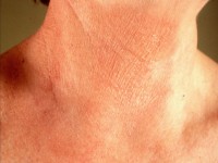 contact allergic eczema