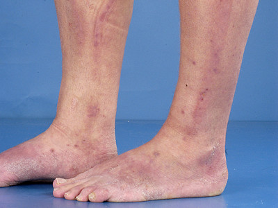 eczema contactallergicum op laarzen