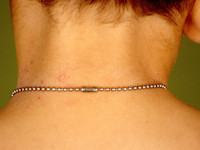 contact allergic eczema