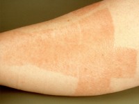 contact allergic eczema