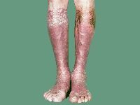 Contactdermatitis kousen