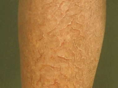 Eczema craquelatum