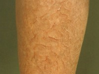 Eczema craquelatum