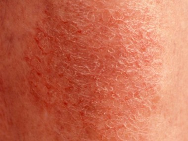 Eczema craquelatum