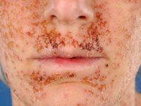 Eczema herpeticum