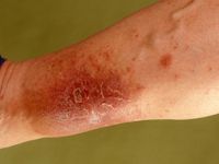 Hypostatic eczema