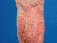 Hypostatic eczema