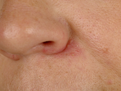 Seborrheic dermatitis