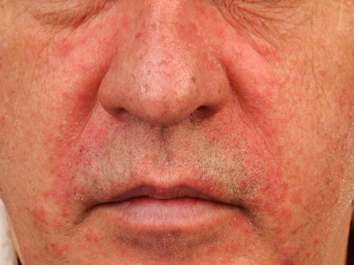 Seborrheic dermatitis