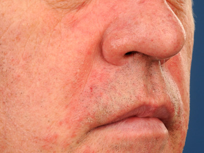 Seborrheic dermatitis