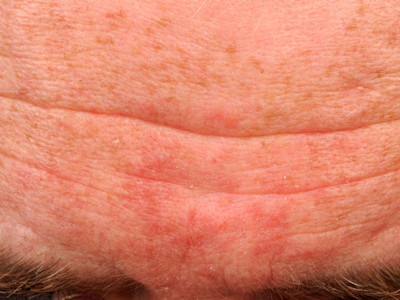 Seborrheic dermatitis