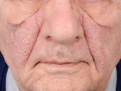 Seborrheic dermatitis