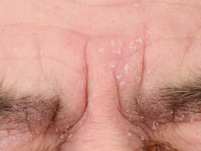 Seborrheic dermatitis