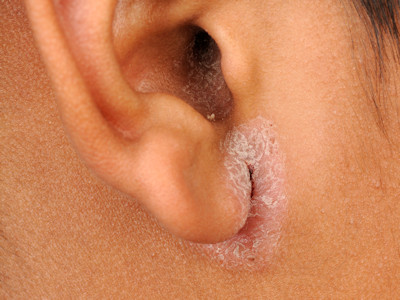 Seborrheic dermatitis