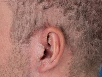 Seborrheic dermatitis