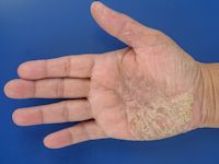 Eczema tyloticum