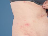 Eikenprocessie rups dermatitis