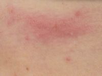 Eikenprocessie rups dermatitis