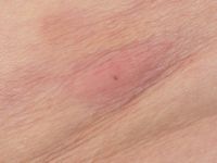 Eikenprocessie rups dermatitis