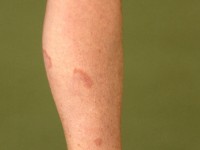 Elastolytic giant cell granuloma