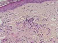 Elastolytic giant cell granuloma