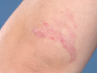 Elastosis perforans serpiginosa