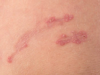 Elastosis perforans serpiginosa