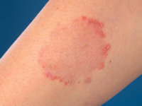 Elastosis perforans serpiginosa