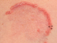 Elastosis perforans serpiginosa