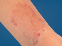 Elastosis perforans serpiginosa