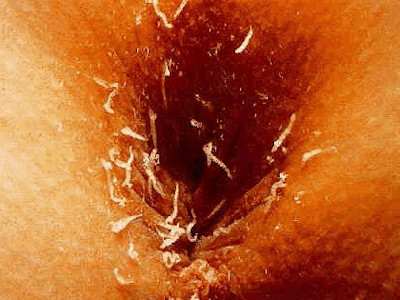 Enterobius vermicularis