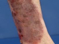 Eosinofiele cellulitis (Wells syndroom)
