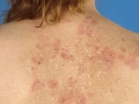 Eosinofiele cellulitis (Wells syndroom)