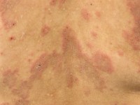 Eosinofiele cellulitis (Wells syndroom)