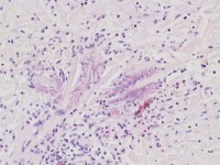 Eosinofiele cellulitis (Wells syndroom)