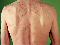 Eosinofiele folliculitis