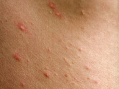 Eosinophilic folliculitis