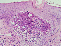 Eosinofiele folliculitis