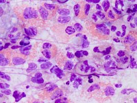 Eosinophilic granulocytes in a follicular pustule