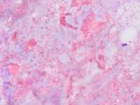 Diff-Quick preparaat met eosinofielen