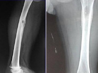 Bothaard langerhanscellen