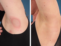 Eosinophilic annular erythema