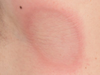 Eosinophilic annular erythema